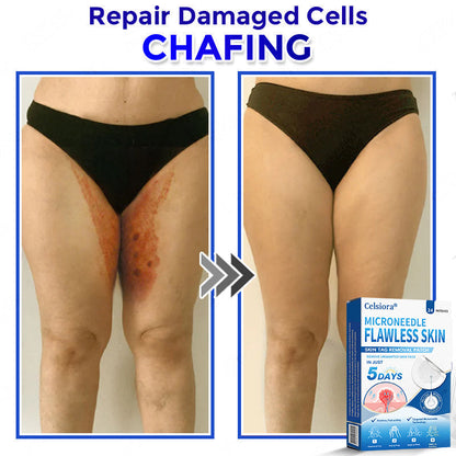 👑☘️Celsiora® 2-in-1 Microneedle & Hydrocolloid Patch | Raised Moles,Acne, Flat Warts & Skin Tags Remover | Improves Wrinkles, Scars & Blemishes | Invisible Pimple Patches for Face & Body | 24 Count