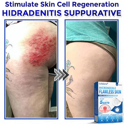 👑☘️Celsiora® 2-in-1 Microneedle & Hydrocolloid Patch | Raised Moles,Acne, Flat Warts & Skin Tags Remover | Improves Wrinkles, Scars & Blemishes | Invisible Pimple Patches for Face & Body | 24 Count