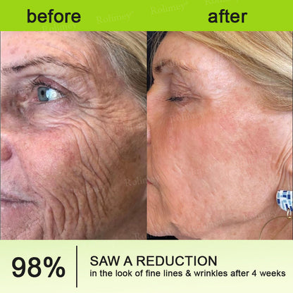 💫💫Made and shipped from the UK 💫Rolimey® Botox & Vita-A Retinol Shot Wrinkle-Lift Tightening cream - Last Day Promotion 50% OFF