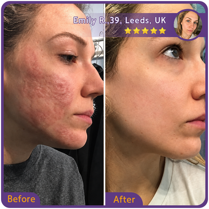 🇬🇧👨‍⚕️🌿Trilumia® Medical-Grade Silicone Scar Repair Roller (For Raised, Red, Firm, Tight & Discoloured Surgical Scars)