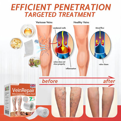 🌿🌿Official UK Store 🇬🇧 | Celsiora® Vein Ease Microneedle Care Patch(For Spider Veins, Varicose Veins, Swelling & Leg Fatigue) - Last Day Promotion 50% OFF