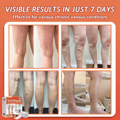 🌿🌿Official UK Store 🇬🇧 | Celsiora® Vein Ease Microneedle Care Patch(For Spider Veins, Varicose Veins, Swelling & Leg Fatigue) - Last Day Promotion 50% OFF