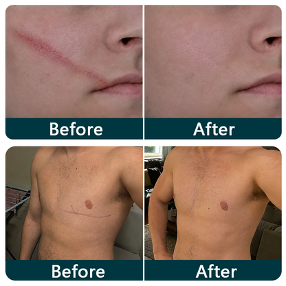 🇬🇧🌿👩‍⚕️TRILUMIA® SILICONE SCAR THERAPY ROLL  Help Soften, Flatten & Improve the Appearance of Raised Scars