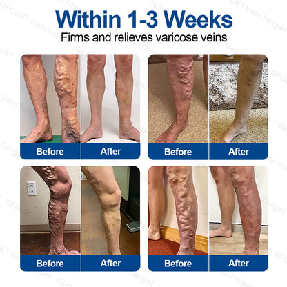 🇬🇧👨‍⚕️✅✅GFOUK® VeinTarget Microneedle Patch⚡Instant Relief, Long-Term Results