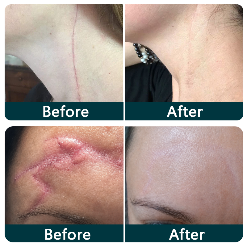 🇬🇧🌿👩‍⚕️TRILUMIA® SILICONE SCAR THERAPY ROLL  Help Soften, Flatten & Improve the Appearance of Raised Scars