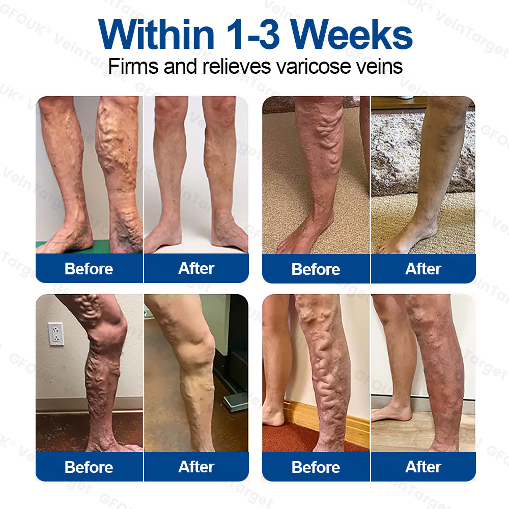 🇬🇧👨‍⚕️👨‍⚕️GFOUK® VeinTarget Microneedle Patch⚡Instant Relief, Long-Term Results