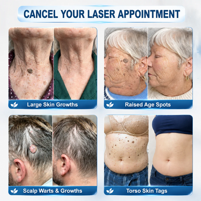 😍💖Evolvion® 𝟕-𝐃𝒂𝘆 𝐒𝗸𝐢𝐧 𝐓𝒂𝗴 & 𝐒𝐩𝙤𝐭 𝐄𝐫𝒂𝐬𝙚𝐫 Painless & Scar-Free Advanced Imperfection Remova𝗜 Ro𝗜𝗜erba𝗜𝗜 Pen 🌿