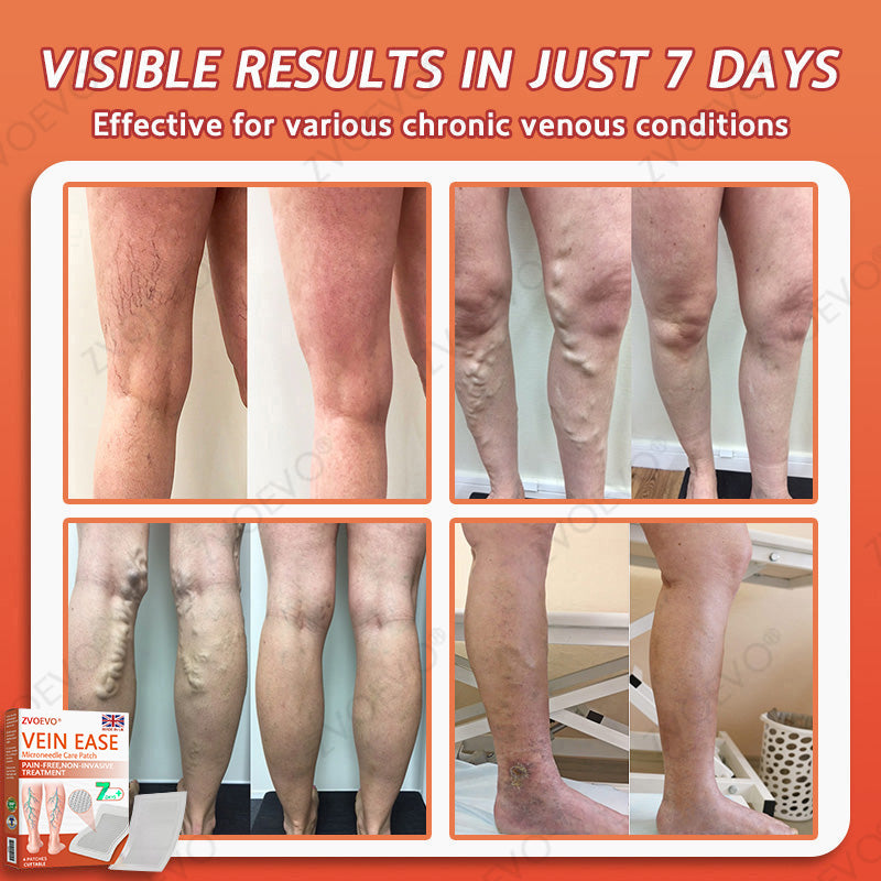 👨‍⚕️Zvoevo® Vein Ease Microneedle Care Patch(For Spider Veins, Varicose Veins, Swelling & Leg Fatigue) - Last Day Promotion 50% OFF