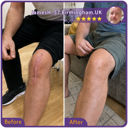 🇬🇧👨‍⚕️🌿Trilumia® Medical-Grade Silicone Scar Repair Roller (For Raised, Red, Firm, Tight & Discoloured Surgical Scars)