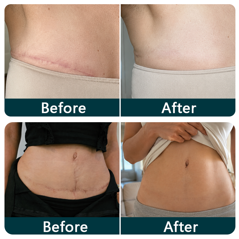 🇬🇧🌿👩‍⚕️TRILUMIA® SILICONE SCAR THERAPY ROLL  Help Soften, Flatten & Improve the Appearance of Raised Scars