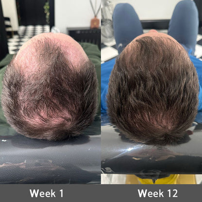 👨‍⚕️✅ Official UK Store 🇬🇧 | 🔥Rolimey® Highly Effective Biotin & Rosemary Hair Growth Serum — Visibly fills thinning areas & receding hairlines (🔥 Limited-Time Offer, ⏳ Last 30 Minutes)