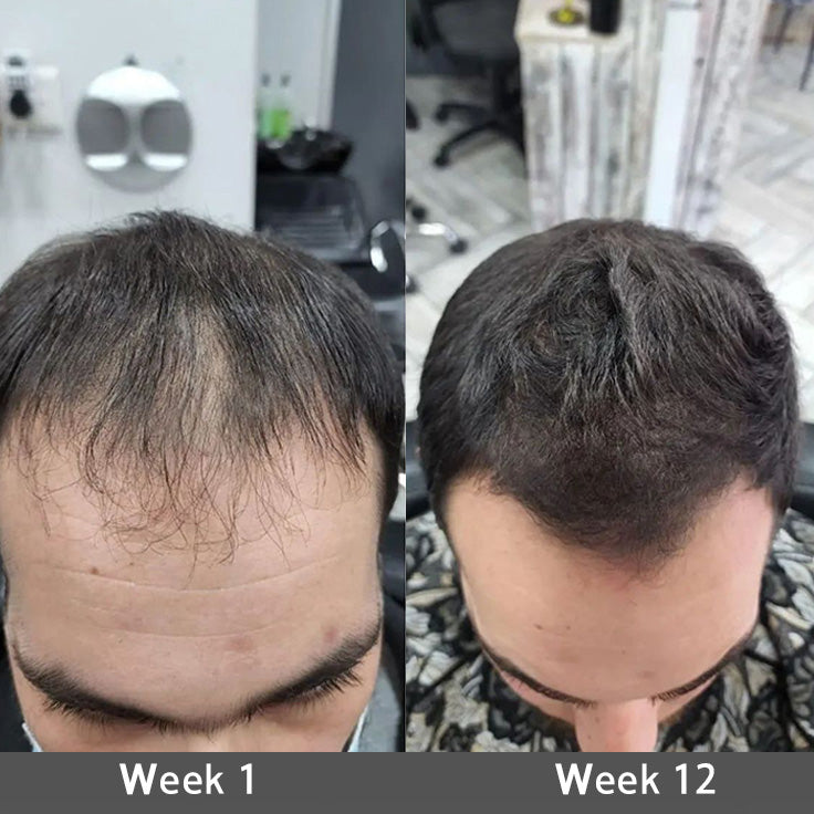 👨‍⚕️✅ Official UK Store 🇬🇧 | 🔥Rolimey® Highly Effective Biotin & Rosemary Hair Growth Serum — Visibly fills thinning areas & receding hairlines (🔥 Limited-Time Offer, ⏳ Last 30 Minutes)