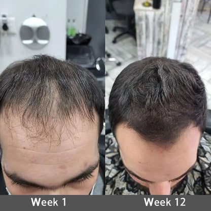 👨‍⚕️✅ Official UK Store 🇬🇧 | 🔥Rolimey® Highly Effective Biotin & Rosemary Hair Growth Serum — Visibly fills thinning areas & receding hairlines (🔥 Limited-Time Offer, ⏳ Last 30 Minutes)