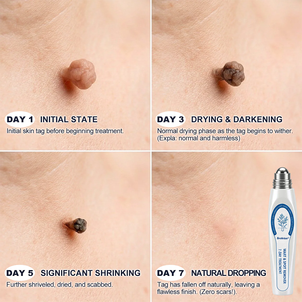 😍💖Evolvion® 𝟕-𝐃𝒂𝘆 𝐒𝗸𝐢𝐧 𝐓𝒂𝗴 & 𝐒𝐩𝙤𝐭 𝐄𝐫𝒂𝐬𝙚𝐫 Painless & Scar-Free Advanced Imperfection Remova𝗜 Ro𝗜𝗜erba𝗜𝗜 Pen 🌿