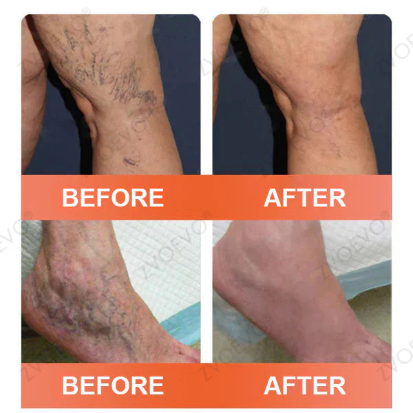 👨‍⚕️Zvoevo® Vein Ease Microneedle Care Patch(For Spider Veins, Varicose Veins, Swelling & Leg Fatigue) - Last Day Promotion 50% OFF