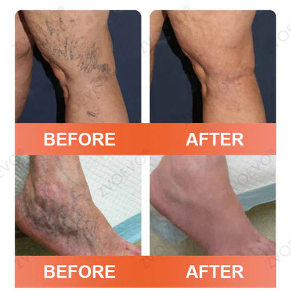 👨‍⚕️Zvoevo® Vein Ease Microneedle Care Patch(For Spider Veins, Varicose Veins, Swelling & Leg Fatigue) - Last Day Promotion 50% OFF