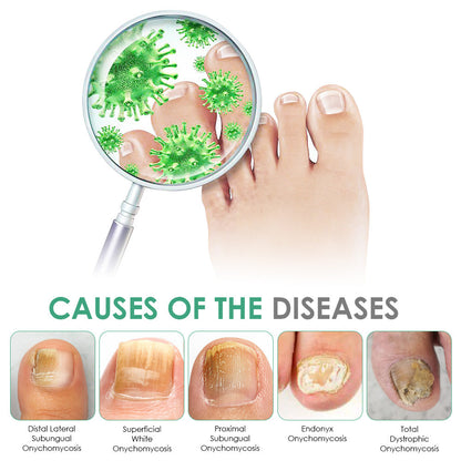 💯👩‍⚕️Official UK Store 🇬🇧 | Celsiora® Max Strength Nail Defense Anti-Fungal Treatment Mousse (Clinically formulated for severe discoloration, keratin thickening, and deep-seated fungal damage.)