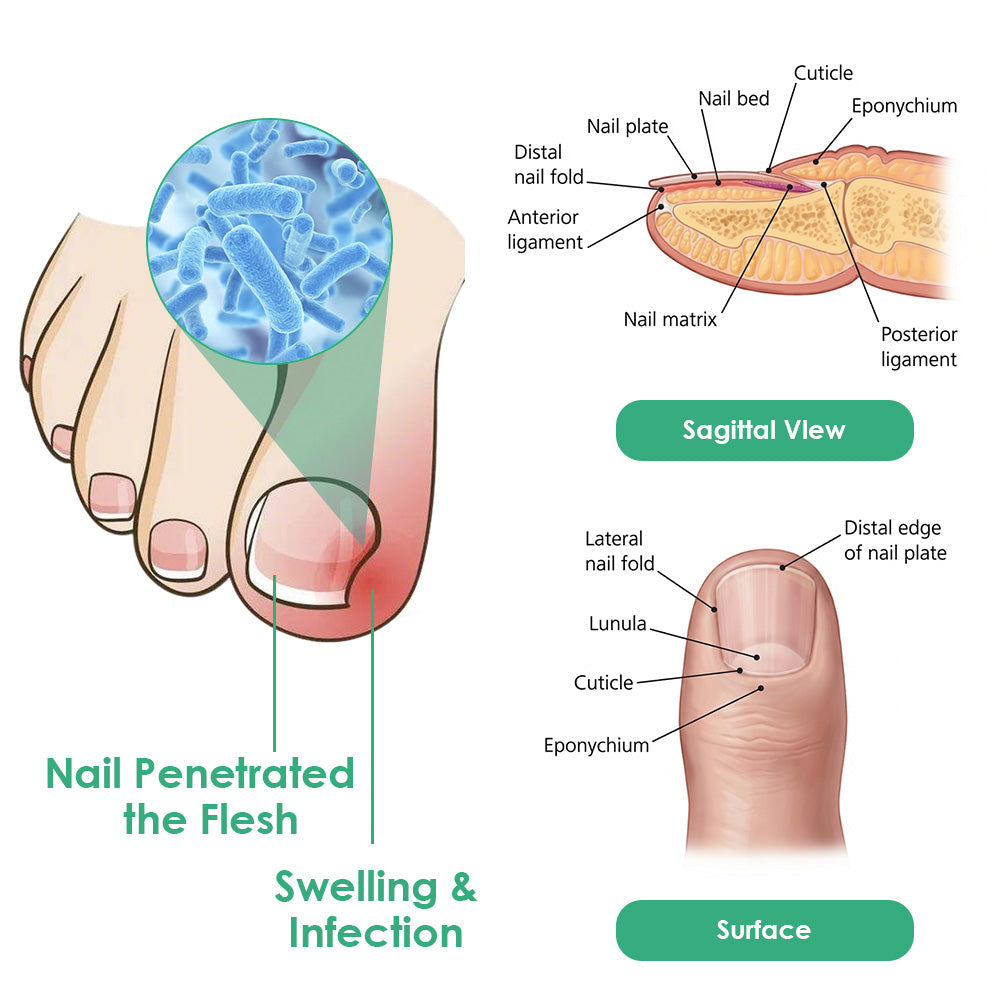 💯👩‍⚕️Official UK Store 🇬🇧 | Celsiora® Max Strength Nail Defense Anti-Fungal Treatment Mousse (Clinically formulated for severe discoloration, keratin thickening, and deep-seated fungal damage.)