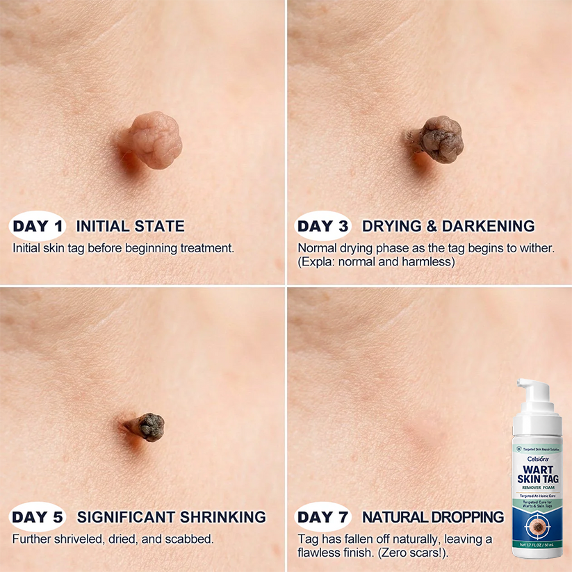🇬🇧🌿✨Celsiora® 7 Day Wart & Skin Tag Remover Foam (Targeted Solution for Warts, Skin Tags & Uneven Skin Texture)