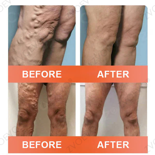 👨‍⚕️Zvoevo® Vein Ease Microneedle Care Patch(For Spider Veins, Varicose Veins, Swelling & Leg Fatigue) - Last Day Promotion 50% OFF